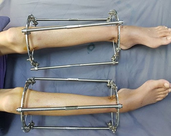 Phẫu thuật kéo chân có thể để lại nhiều biến chứng nguy hiểm