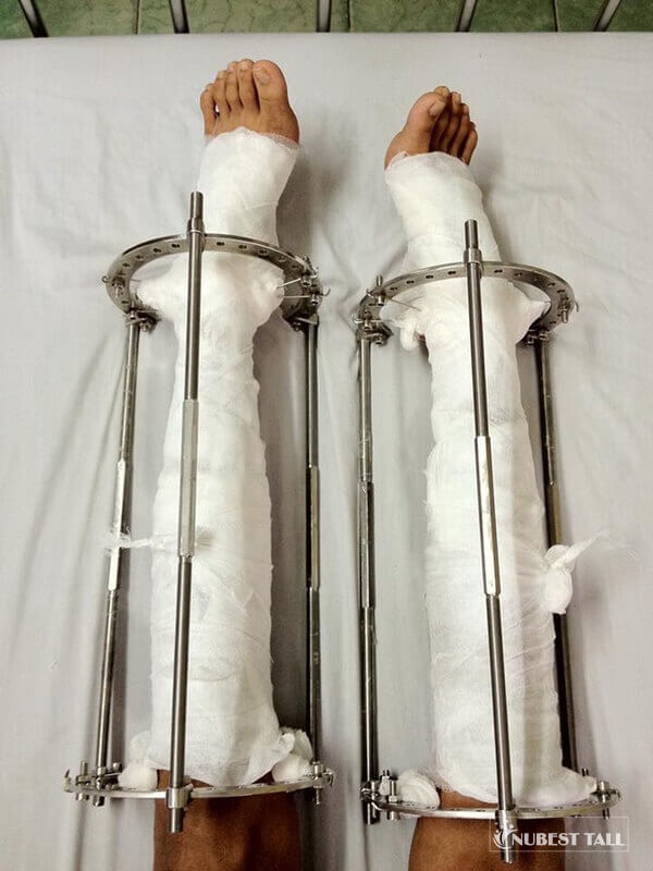 Phương pháp tăng chiều cao nhờ phẫu thuật kéo dài chân